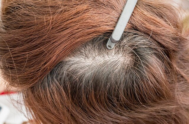 Managing Hair Loss Due to Medical Treatments: Support and Solutions