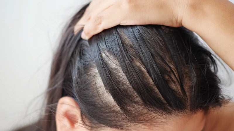 Managing Postpartum Hair Loss: What to Expect & How to Mitigate