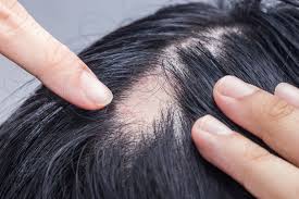 Living with Alopecia? Learn How to Manage Hair Loss and Find Support
